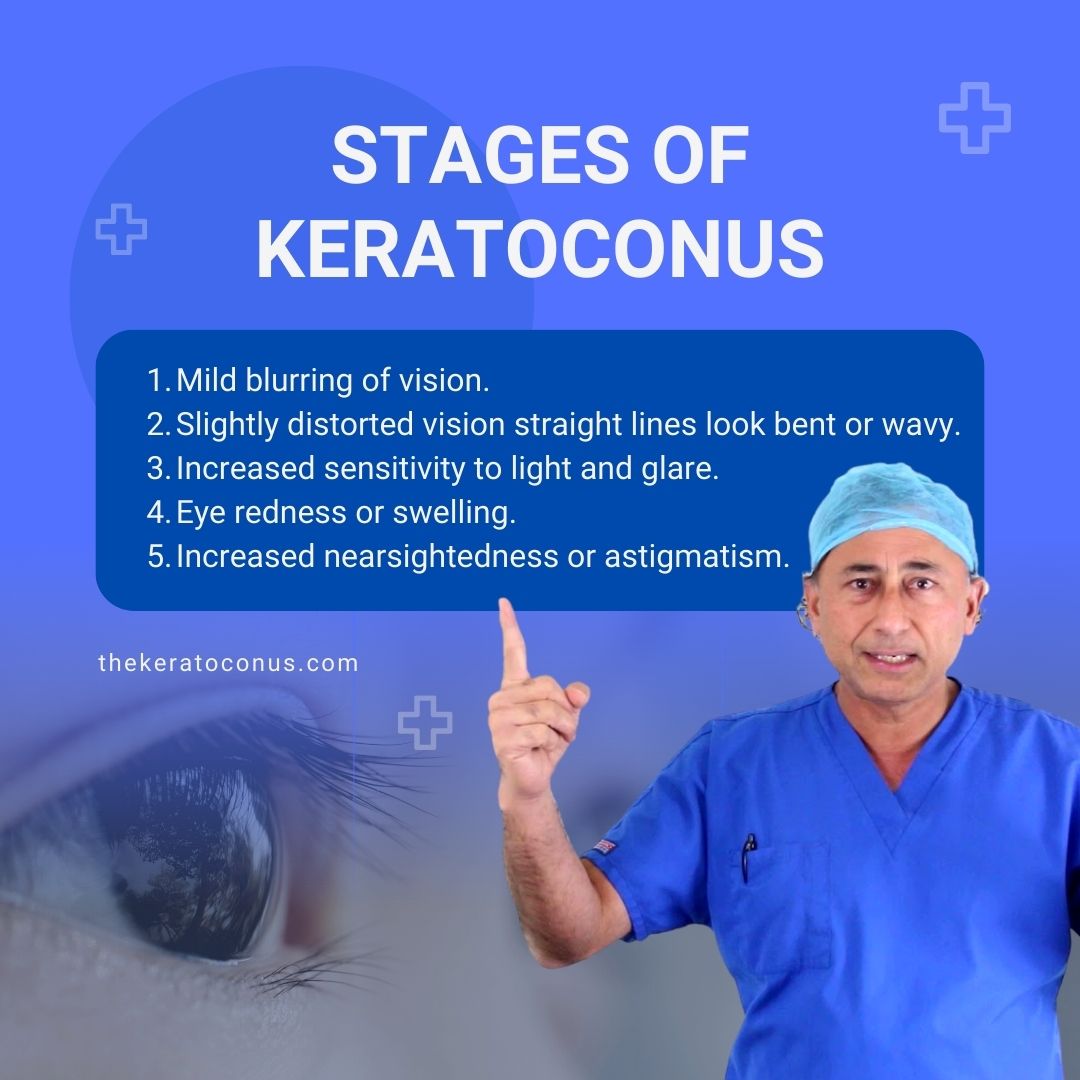 Stages Of Keratoconus